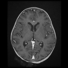 File:Cerebral and spinal tuberculosis (Radiopaedia 90489-107837 Axial T1 C+ 107).jpg