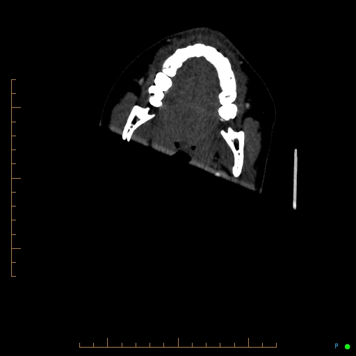 Cerebral arteriovenous malformation (AVM) (Radiopaedia 78162-90706 Axial CTA 4).jpg