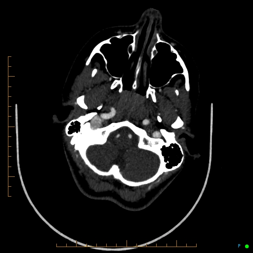 Cerebral arteriovenous malformation (AVM) (Radiopaedia 78162-90706 Axial CTA 55).jpg