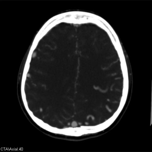 Cerebral arteriovenous malformation (Radiopaedia 28518-28759 B 40).jpg