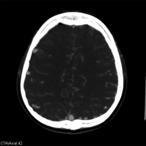 File:Cerebral arteriovenous malformation (Radiopaedia 28518-28759 B 42).jpg