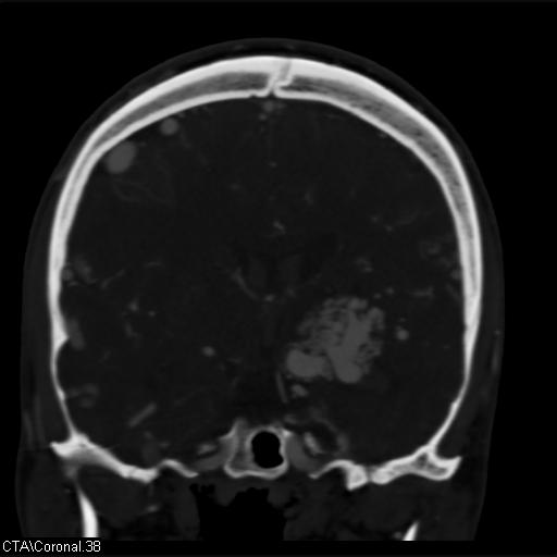 Cerebral arteriovenous malformation (Radiopaedia 28518-28759 C 38).jpg