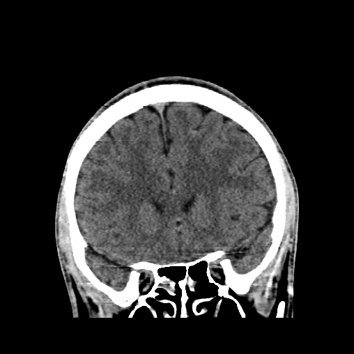 File:Cerebral arteriovenous malformation (Radiopaedia 61964-70028 Coronal non-contrast 20).jpg
