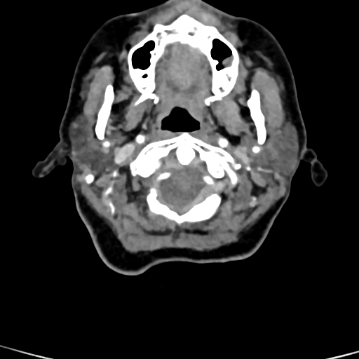 Cerebral arteriovenous malformation (Radiopaedia 73830-84645 B 95).jpg