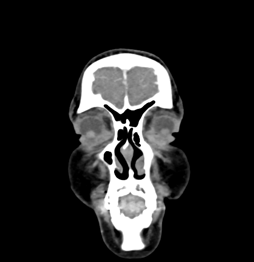 Cerebral arteriovenous malformation (Radiopaedia 73830-84645 C 10).jpg
