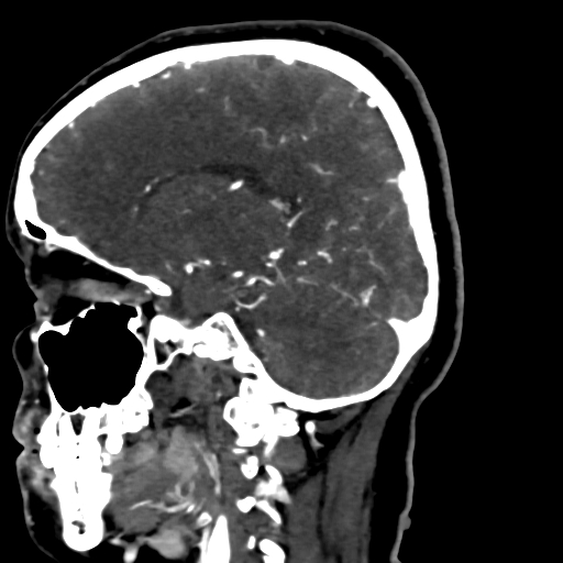 Cerebral arteriovenous malformation (Radiopaedia 73830-84645 Sagittal C+ delayed 36).jpg