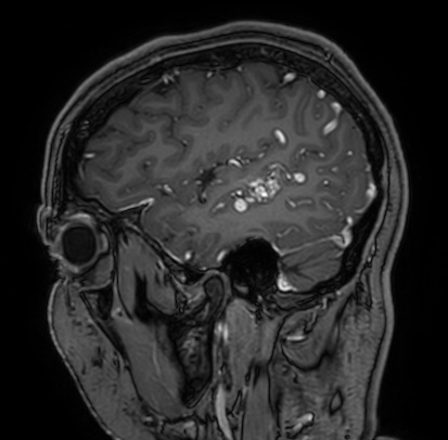 Cerebral arteriovenous malformation (Radiopaedia 74411-85654 Sagittal T1 C+ 23).jpg