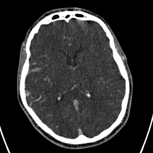 Cerebral arteriovenous malformation (Radiopaedia 78188-90746 Axial C+ delayed 93).jpg