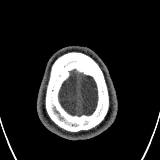 Cerebral arteriovenous malformation (Radiopaedia 78188-90746 Axial non-contrast 169).jpg
