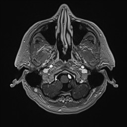 Cerebral arteriovenous malformation (Radiopaedia 84015-99245 Axial T1 C+ 27).jpg