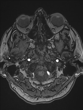 Cerebral arteriovenous malformation (Radiopaedia 84015-99245 Axial TOF 51).jpg