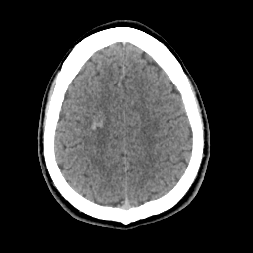 File:Cerebral arteriovenous malformation (Spetzler-Martin grade 2) (Radiopaedia 41262-44076 Axial non-contrast 42).png