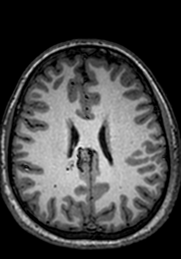 Cerebral arteriovenous malformation at posterior body of corpus callosum (Radiopaedia 74111-84925 Axial T1 100).jpg