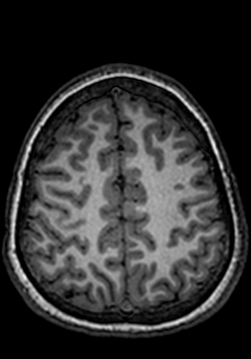 Cerebral arteriovenous malformation at posterior body of corpus callosum (Radiopaedia 74111-84925 Axial T1 60).jpg