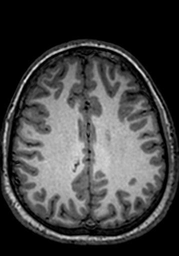 Cerebral arteriovenous malformation at posterior body of corpus callosum (Radiopaedia 74111-84925 Axial T1 88).jpg