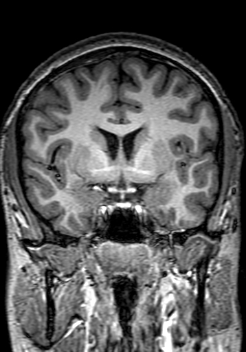 Cerebral arteriovenous malformation at posterior body of corpus callosum (Radiopaedia 74111-84925 Coronal T1 134).jpg