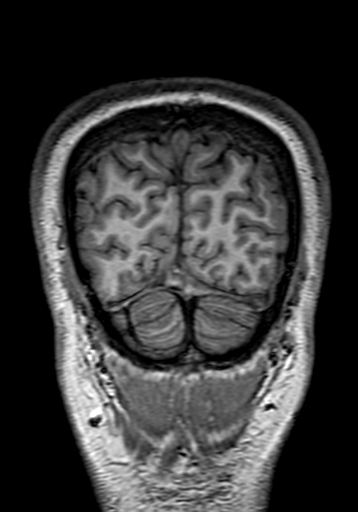 Cerebral arteriovenous malformation at posterior body of corpus callosum (Radiopaedia 74111-84925 Coronal T1 317).jpg