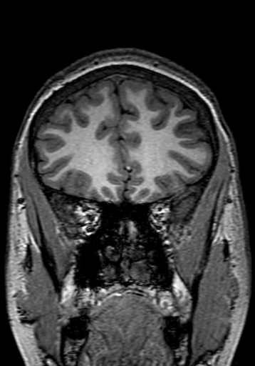 Cerebral arteriovenous malformation at posterior body of corpus callosum (Radiopaedia 74111-84925 Coronal T1 67).jpg