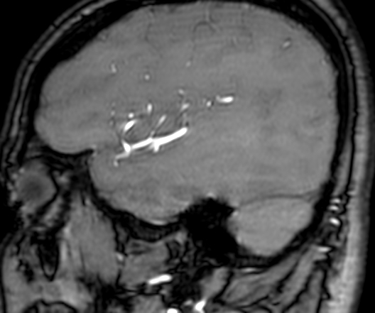 Cerebral arteriovenous malformation at posterior body of corpus callosum (Radiopaedia 74111-84925 J 68).jpg