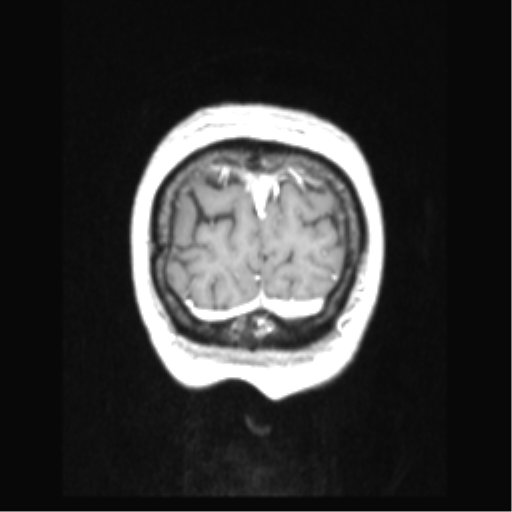 Cerebral arteriovenous malformation with hemorrhage (Radiopaedia 34422-35737 Coronal T1 C+ 10).png