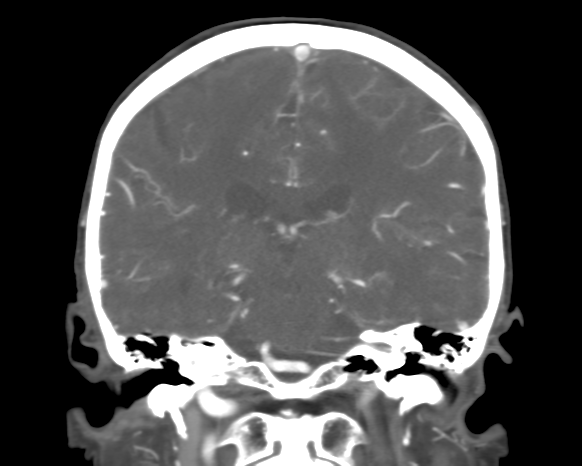 Cerebral arteriovenous malformation with lobar hemorrhage (Radiopaedia 44725-48511 A 35).png