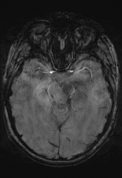 File:Cerebral cavernoma and development venous anomaly (Radiopaedia 37603-39482 Axial SWI 16).png