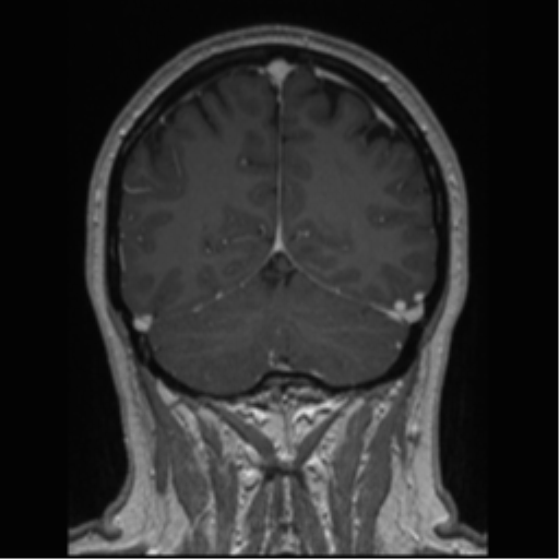 Cerebral cavernoma and development venous anomaly (Radiopaedia 37603-39482 Coronal T1 C+ 26).png