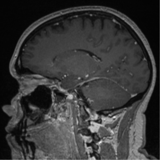 File:Cerebral cavernoma and development venous anomaly (Radiopaedia 37603-39482 Sagittal T1 C+ 40).png