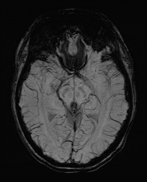Cerebral cavernous venous malformation (Radiopaedia 70008-80021 Axial SWI 30).jpg