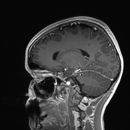 Cerebral cavernous venous malformation (Radiopaedia 70008-80021 Sagittal T1 C+ 28).jpg