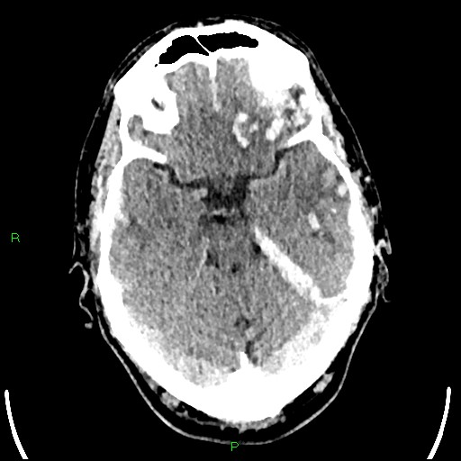 File:Cerebral contusions (Radiopaedia 33868-35039 Axial non-contrast 71).jpg