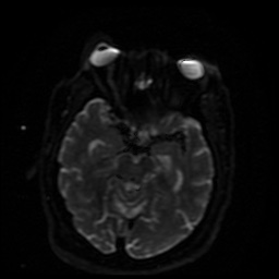 File:Cerebral embolic infarcts (embolic shower) (Radiopaedia 49837-55108 Axial DWI 30).jpg