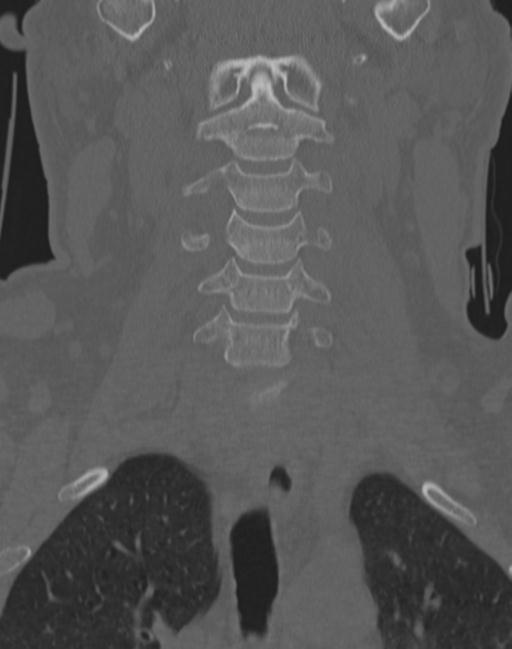 Cerebral hemorrhagic contusions and cervical spine fractures (Radiopaedia 32865-33841 Coronal bone window 24).jpg