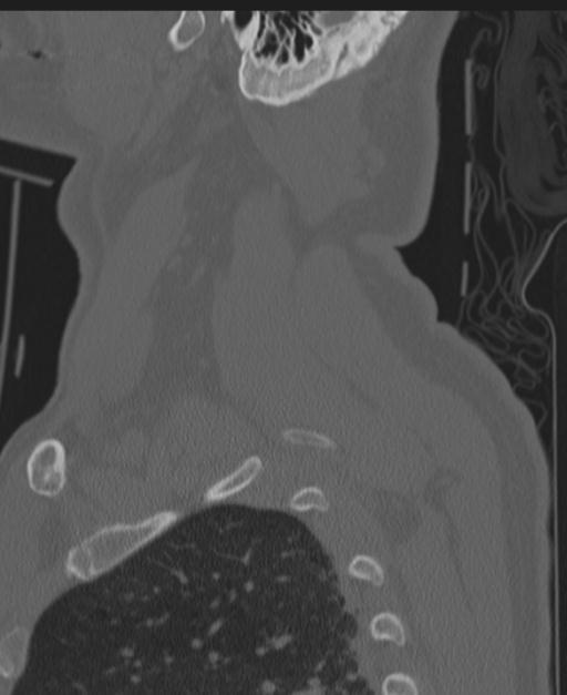Cerebral hemorrhagic contusions and cervical spine fractures (Radiopaedia 32865-33841 Sagittal bone window 89).jpg