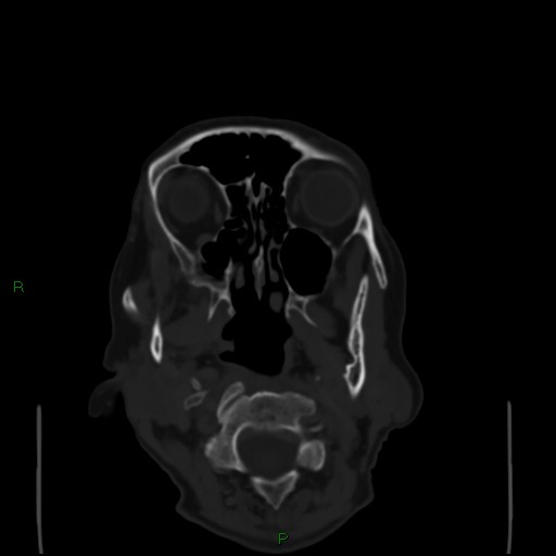 Cerebral metastases - breast primary (Radiopaedia 77653-89857 Axial bone window 5).jpg