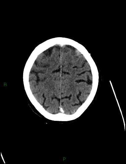 Cerebral metastases - ependymal and parenchymal (Radiopaedia 79877-93131 Axial C+ delayed 67).jpg
