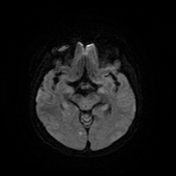 Cerebral metastases - melanoma (Radiopaedia 80972-94522 Axial DWI 14).jpg