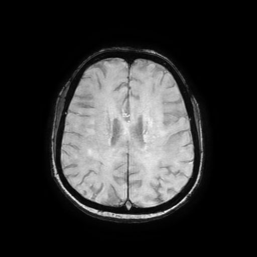 Cerebral metastases - melanoma (Radiopaedia 80972-94522 Axial SWI 66).jpg