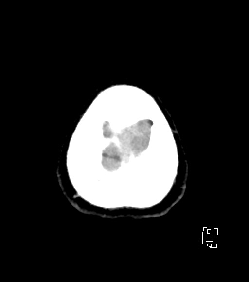 Cerebral metastases - testicular choriocarcinoma (Radiopaedia 84486-99855 Axial non-contrast 7).jpg