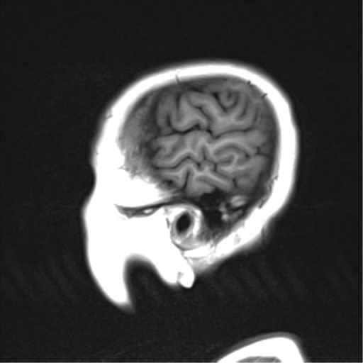 File:Cerebral metastases mimicking abscesses (Radiopaedia 45841-50131 G 2).png