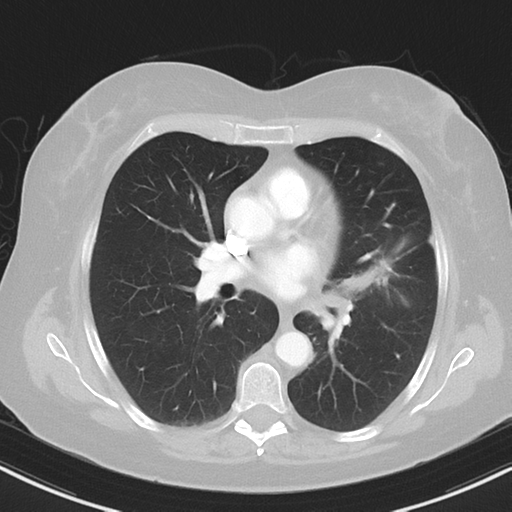 File:Cerebral metastasis mimicking glioblastoma (Radiopaedia 69155-78938 Axial lung window 23).png
