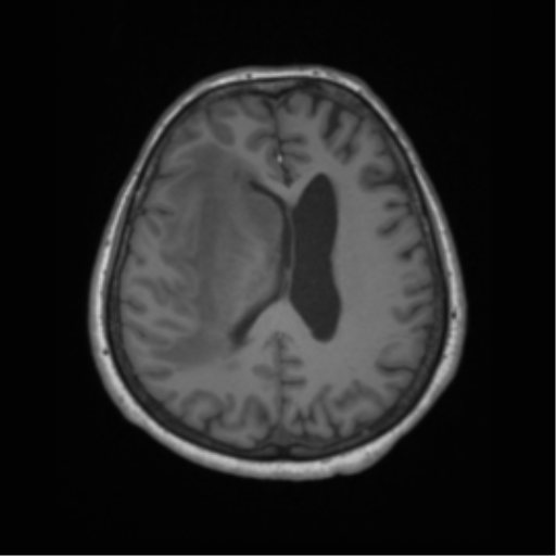 Cerebral metastasis to basal ganglia (Radiopaedia 81568-95413 Axial T1 47).png