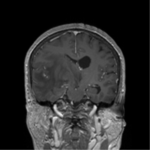 File:Cerebral metastasis to basal ganglia (Radiopaedia 81568-95413 Coronal T1 C+ 25).png