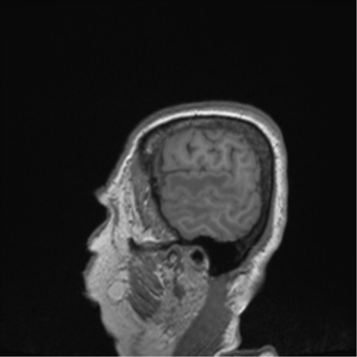 Cerebral metastasis to basal ganglia (Radiopaedia 81568-95413 Sagittal T1 70).png
