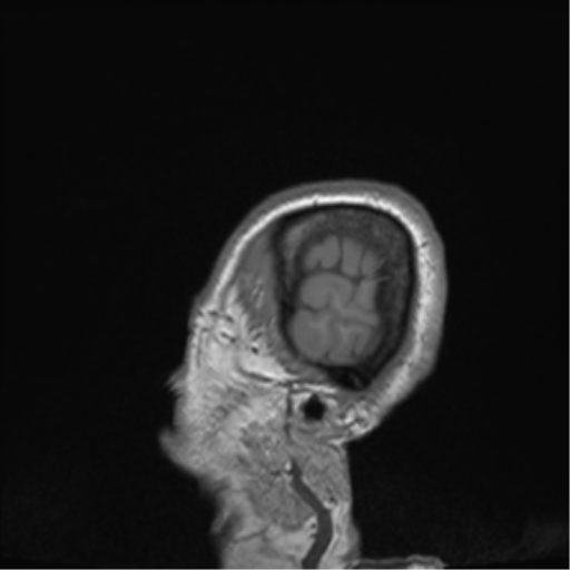 Cerebral metastasis to basal ganglia (Radiopaedia 81568-95413 Sagittal T1 74).png