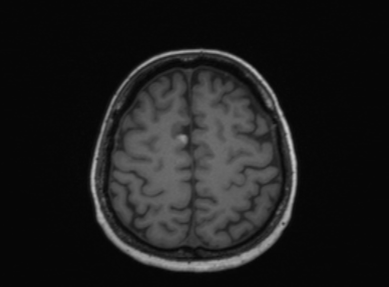 Cerebral ring enhancing lesions - cerebral metastases (Radiopaedia 44922-48817 Axial T1 152).jpg