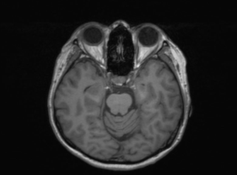 Cerebral ring enhancing lesions - cerebral metastases (Radiopaedia 44922-48817 Axial T1 270).jpg