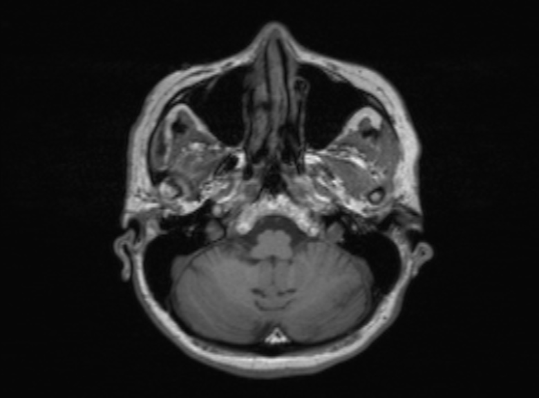 Cerebral ring enhancing lesions - cerebral metastases (Radiopaedia 44922-48817 Axial T1 320).jpg