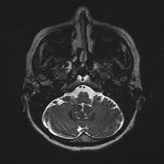 Cerebral ring enhancing lesions - cerebral metastases (Radiopaedia 44922-48817 F 17).jpg