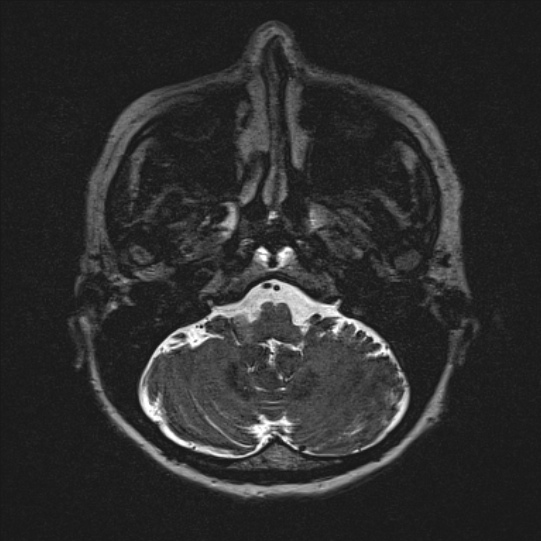 Cerebral ring enhancing lesions - cerebral metastases (Radiopaedia 44922-48817 F 18).jpg